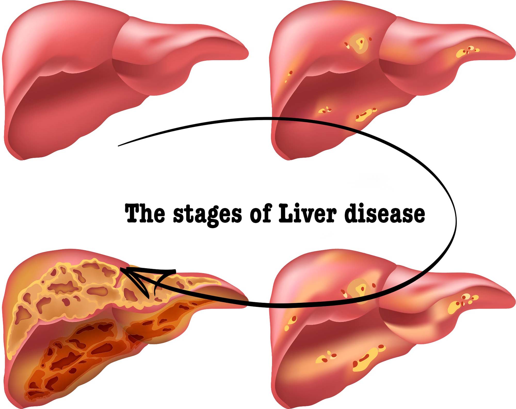 Liver Disease Prediction